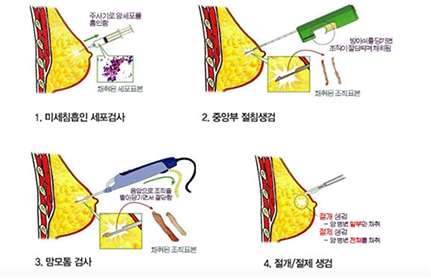 유방조직