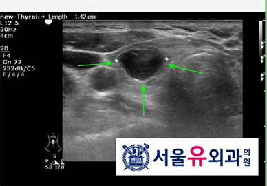 유방조직