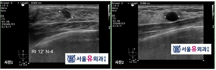 유방조직